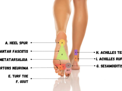 bottom of foot pain diagram